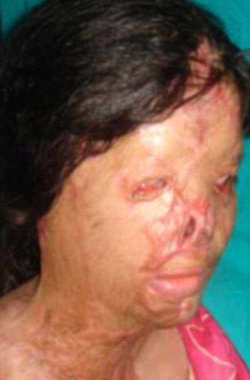 بالصور .. صديقتها الغيورة سكبت على وجهها أحماض حارقة .. شاهدوا شكلها بعد سنوات من العمليات !