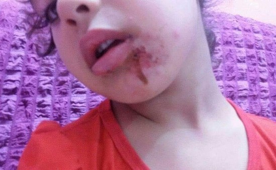 بالصور.. طفلة عراقية تعرضت للتعذيب والحرق على يد جدتها