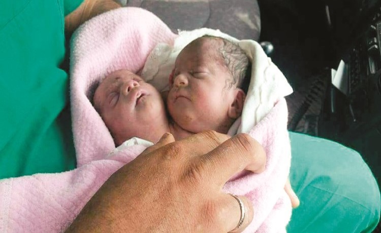 صورة تداولها ناشطون للطفلة ذات الرأسين المولودة في إدلب	(انترنت)﻿