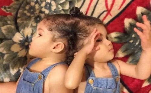 الإعلان عن تعذر فصل التوأم المصري "مي ومنة" لخطورة الحالة