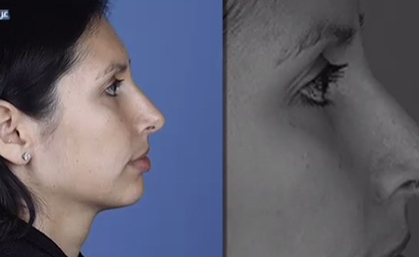 "معضلة الأنف".. حلم الكثيرين بات متاحا