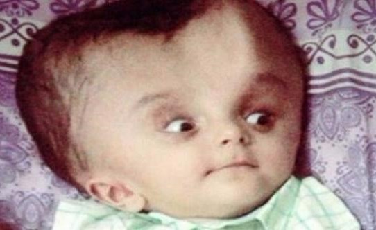 عملية جراحية لطفل ولد برأس مشوه بفضل متبرع مجهول