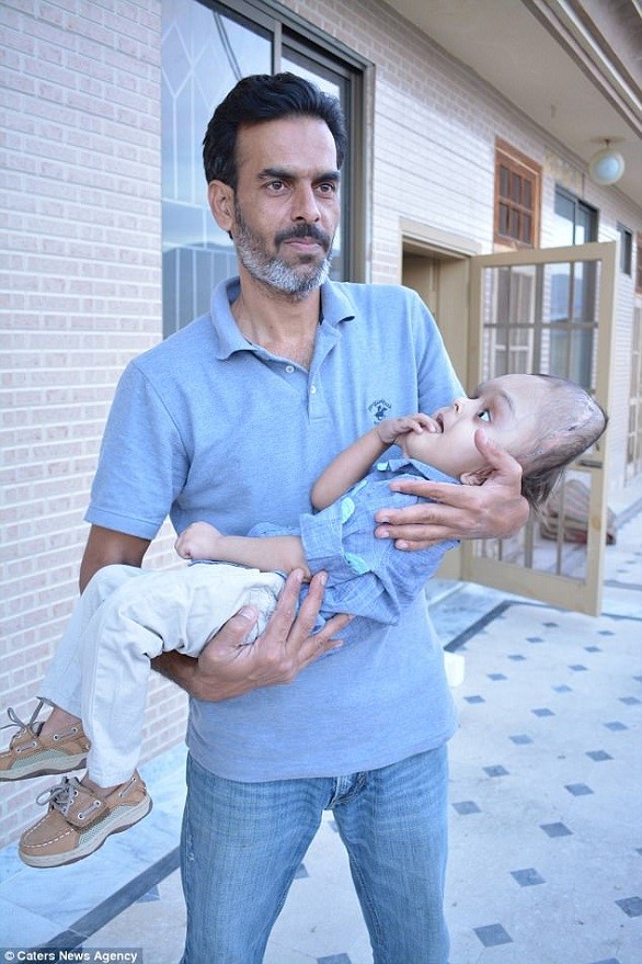 عملية جراحية لطفل ولد برأس مشوه بفضل متبرع مجهول