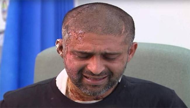 بالصور.. مسلمان تعرضا لاعتداء بالأسيد في لندن: لماذا لا يصنف ارهاباً؟