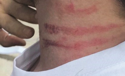 آثار الاعتداء على رقبة اليتيم ﻿