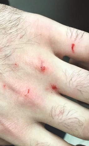إصابات بظهر كفه وأصابعه ﻿