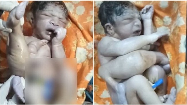 بالفيديو.. طفل يولد بـ4 سيقان و3 أذرع في الهند