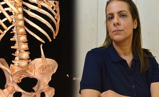 تركية تكتشف مقصا في معدتها بعد 6 أشهر من إجرائها عملية تجميل