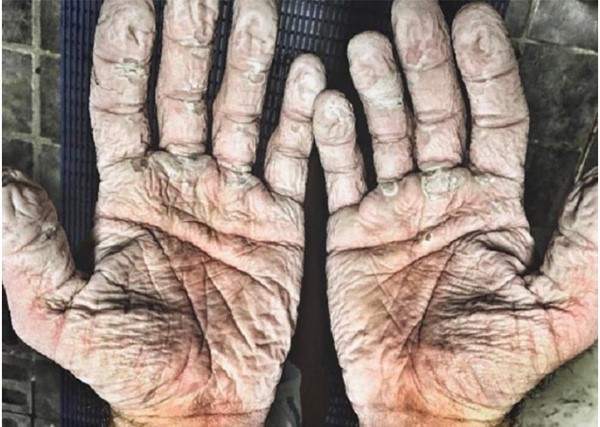 صورة صادمة.. هكذا تبدو أيدي البطل الأولمبي الذي غزا المحيط المتجمد الشمالي