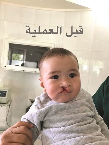 أمين النبهان: 128 عملية جراحية خلال يومين لمخيم الأمل الجراحي الكويتي في قيرغيزيا