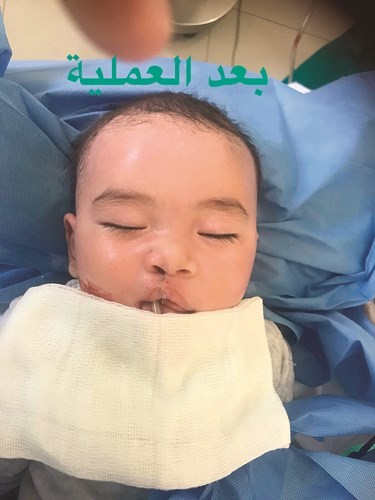 أمين النبهان: 128 عملية جراحية خلال يومين لمخيم الأمل الجراحي الكويتي في قيرغيزيا