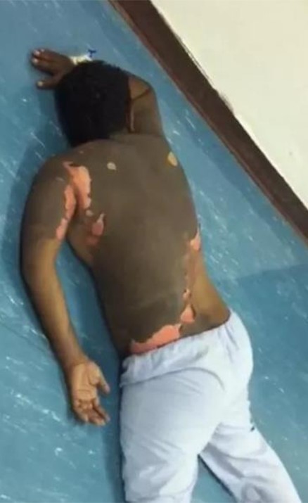 صورة: القبض على المرأة التي سكبت الزيت المغلي على زوجها بعد زواجه بأخرى في السعودية