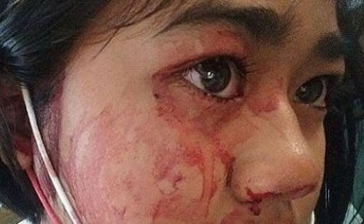 حالتها نادرة جداً والأطباء يحتارون في تشخيصها.. امرأة تتعرَّق "دماً" وتعيش حالة اكتئاب بسبب مرضها الغريب