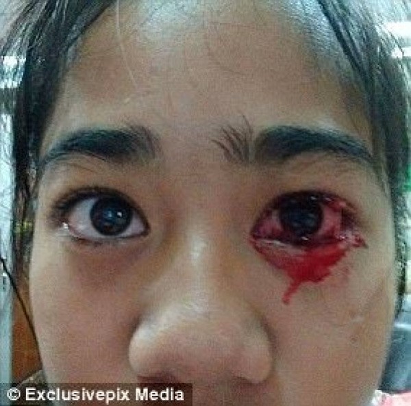 حالتها نادرة جداً والأطباء يحتارون في تشخيصها.. امرأة تتعرَّق "دماً" وتعيش حالة اكتئاب بسبب مرضها الغريب