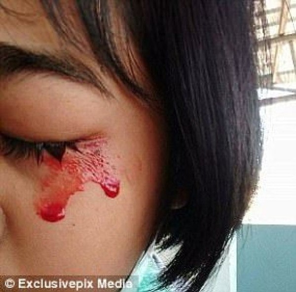 حالتها نادرة جداً والأطباء يحتارون في تشخيصها.. امرأة تتعرَّق "دماً" وتعيش حالة اكتئاب بسبب مرضها الغريب