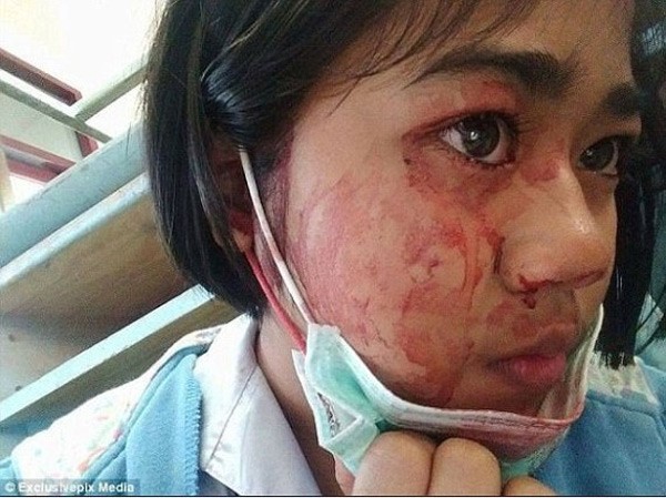 حالتها نادرة جداً والأطباء يحتارون في تشخيصها.. امرأة تتعرَّق "دماً" وتعيش حالة اكتئاب بسبب مرضها الغريب