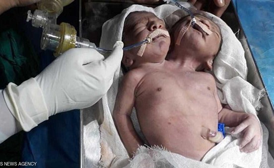 توأم "الواحد في المليون" توفي بعد 24 ساعة