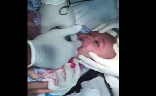 فيديو مروّع .. شاهد ما ذا وجد الطبيب في فم طفل رضيع!