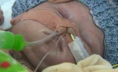 عائلة مجهولة تبرعت لهذا الرضيع بقلب وأنقذت حياته.. عمره 8 أسابيع وخضع لعمليتين جراحيتين