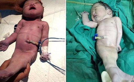 شاهد.. ولادة أول «حورية بحر» في الهند تثير حيرة الأطباء !!