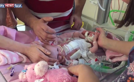 بالفيديو.. إنقاذ "إعجازي" لرضيعة قلبها خارج جسدها