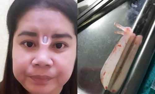 شاهد.. كيف شوهت عملية تجميل فاشلة وجه هذه الفتاة