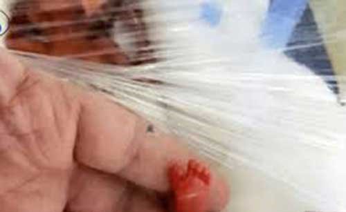 الرضيعة المعجزة.. أخف مولودة بالعالم تنجو من الموت
