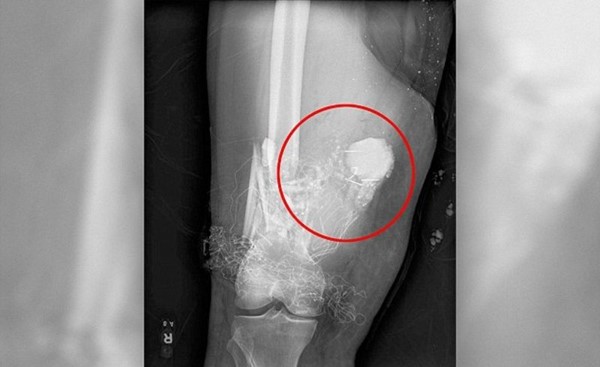 شاهد.. أطباء يستدعون الإطفاء وقوة متفجرات لغرفة العمليات.. قصة الساق المتفجرة