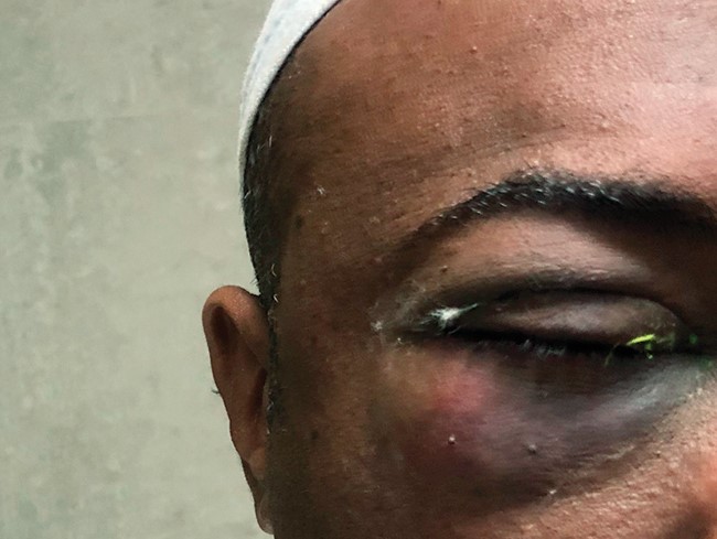 اثار الاعتداء على وجه المعلم