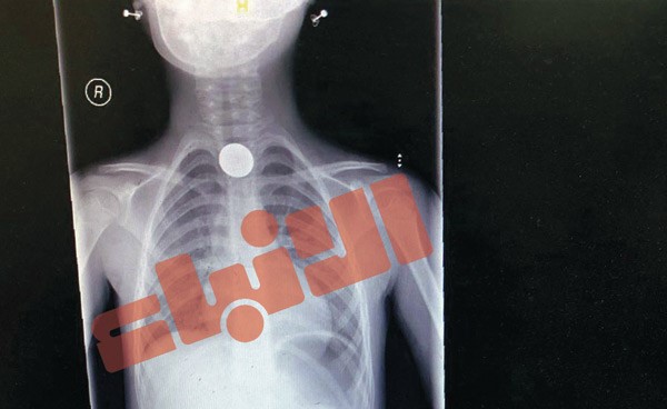 فريق طبي في «الصباح» ينهي معاناة طفلة ابتلعت 100 فلس