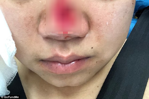 شاهد.. قضمت جزءاً من أنف سيدة أخرى... لماذا دار الشجار بينهما؟