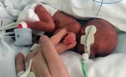 طفل ولد بحجم علبة فول يحتفل بعيد ميلاده الأول بعد تعافيه