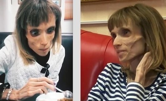 امرأة تزن 17 كغم فقط بسبب حالة صحية نادرة