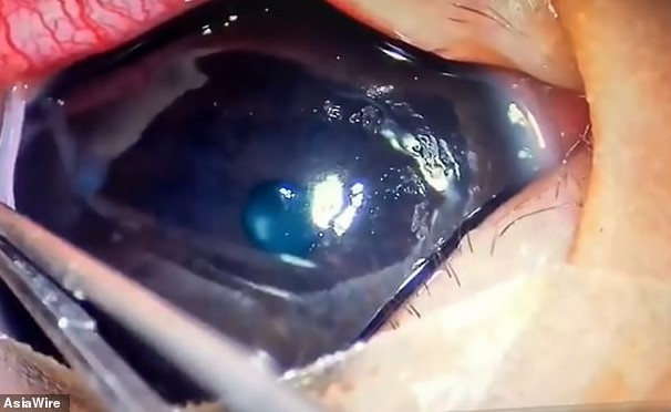 شاهد.. الأطباء يزيلون 11 نوعًا من الديدان الحية من عين رضيع