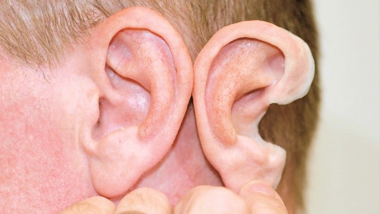 تصنيع الأطراف التعويضية التجميلية بدقة عالية﻿