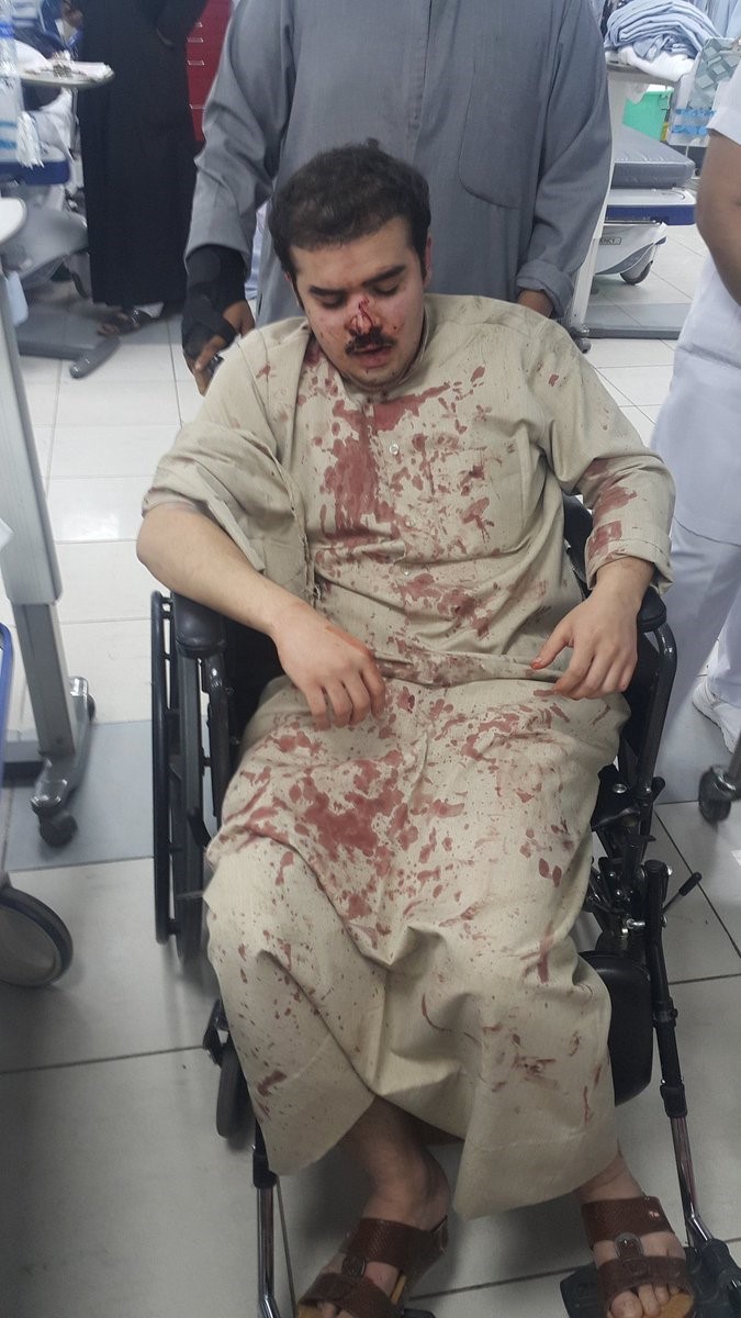 محمد العنزي تعرض لكسر في الانف خلال اعتداء مجهولين عليه بصناعية الجهراء