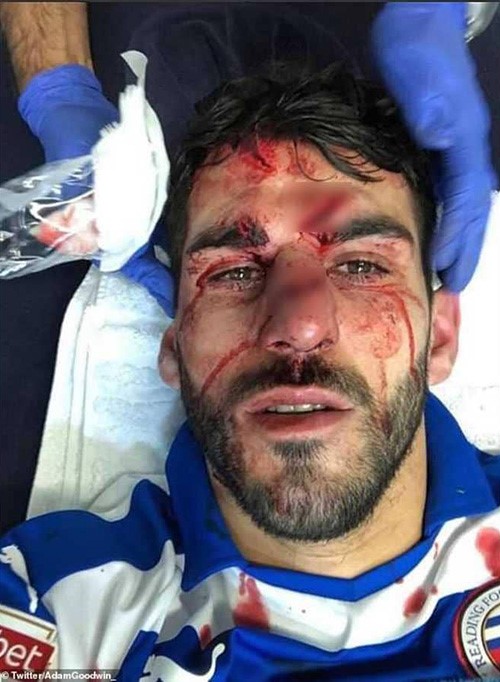 شاهد... لاعب يشوه خصمه بالدوري الإنجليزي.. وفيديو للحظة الإصابة