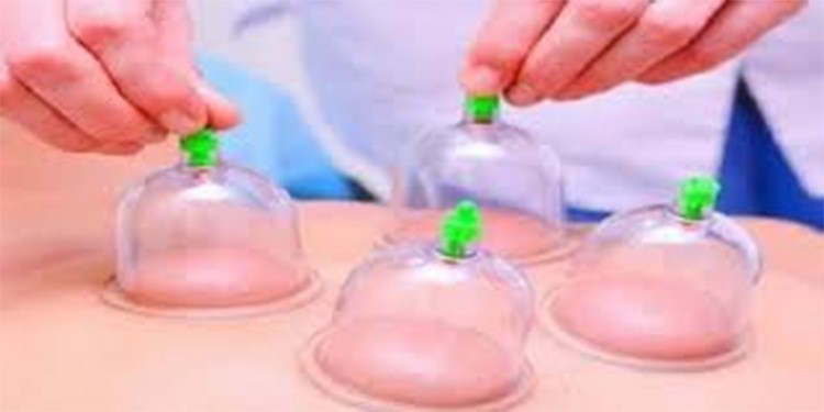 ھل توجد أفضلیة بین حجامتي الرأس والظھر؟ أخصائیة توضح