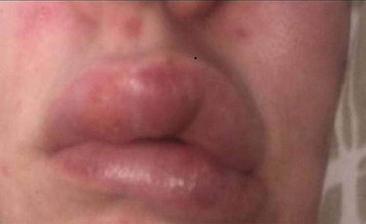 صورة مروعة لامرأة بعد عملية نفخ شفاه "منخفضة الكلفة"