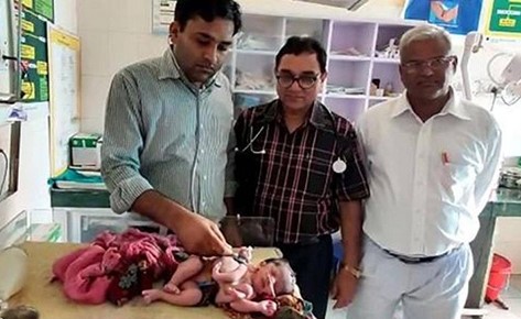 شاهد صدمة طبية بالهند .. ولادة طفلة بأربعة أرجل و3 أيادٍ