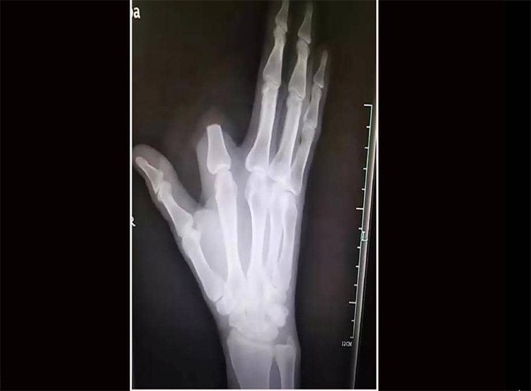 قطع إصبعه بسبب لدغة أفعى.. ثم اكتشف "المفاجأة الصاعقة"