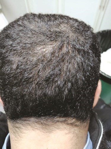 عمليات الزراعة تعتمد على أخذ الشعر من خلف الرأس