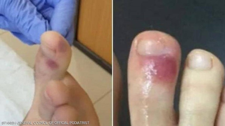 جديد أعراض "كورونا"..قروح وكدمات على الجسم لاسيما عند الأطفال والمراهقين