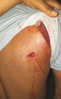 آثار الطعنة على ظهر المجني عليه
