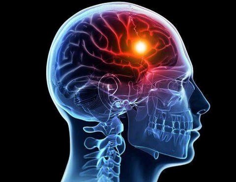 ما أعراض السكتة الدماغية وما الفئات الأكثر عرضة للإصابة؟
