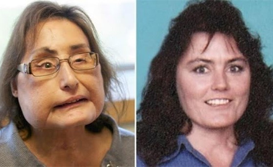 تشوهت بسبب رصاصة من زوجها ... وفاة أول أميركية خضعت لعملية زرع وجه
