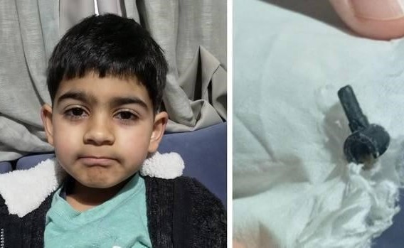 بالفيديو.. قطعة مفقودة من لعبة ليغو تظهر في أنف طفل بعد سنتين