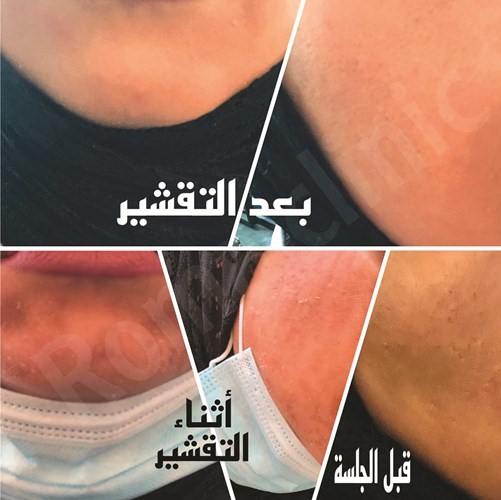 جلسات التقشير