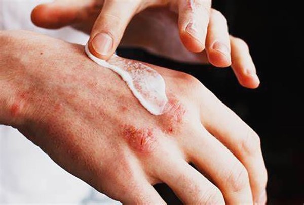 الاستخدام المبالغ للكريمات قد يضر البشرة